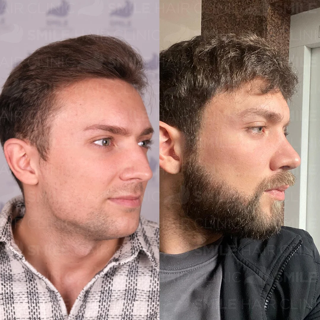 Before and after result 22