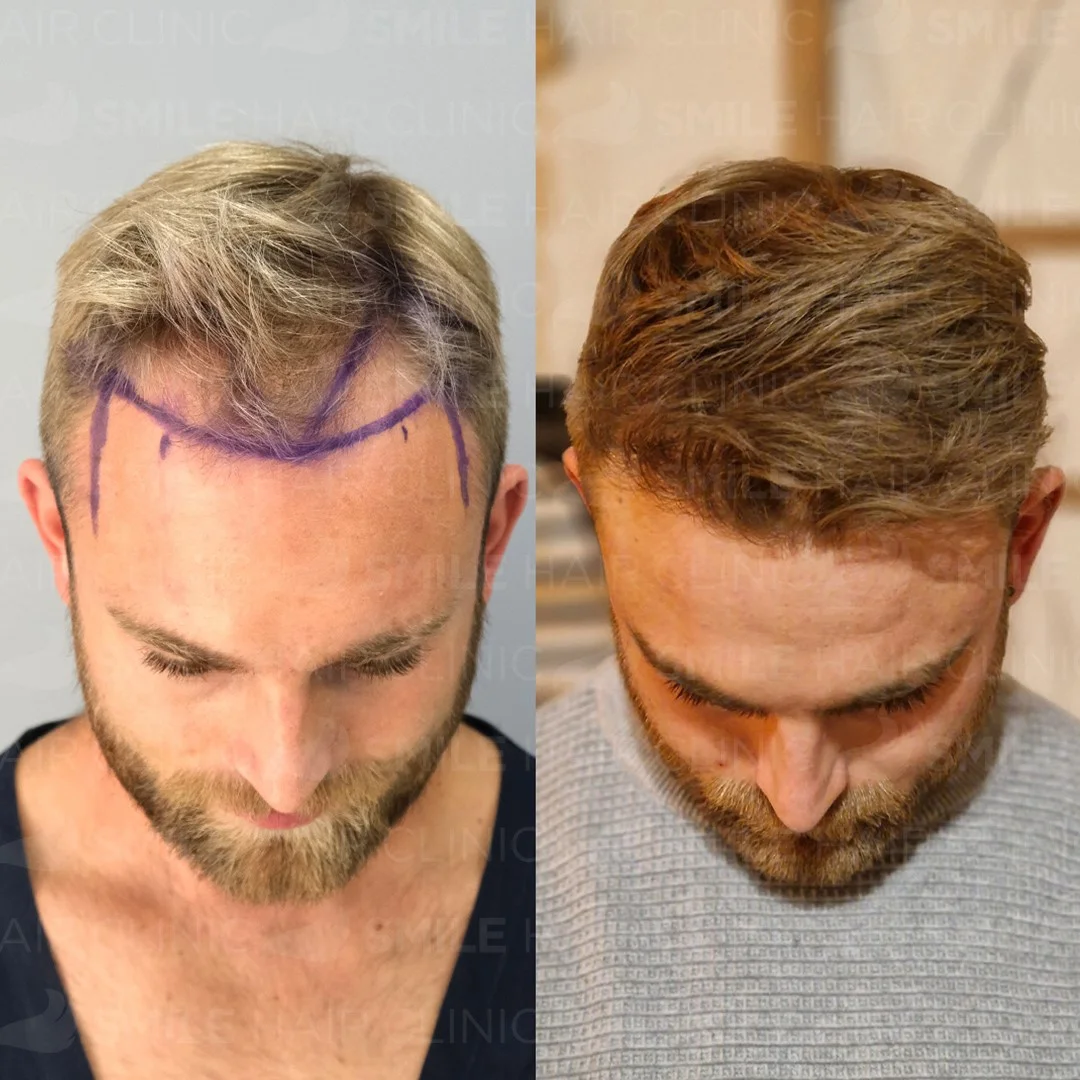 Before and after result 17