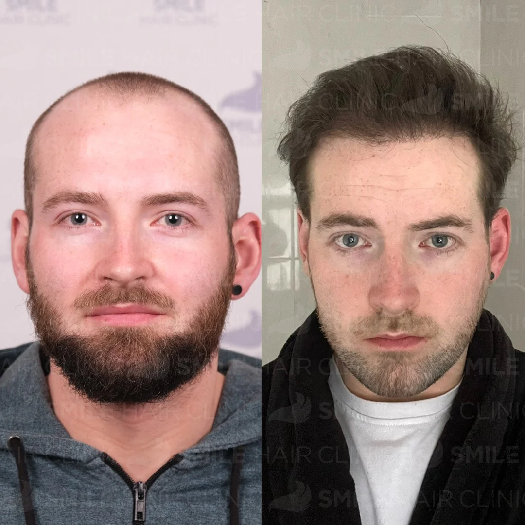 Before and after result 23