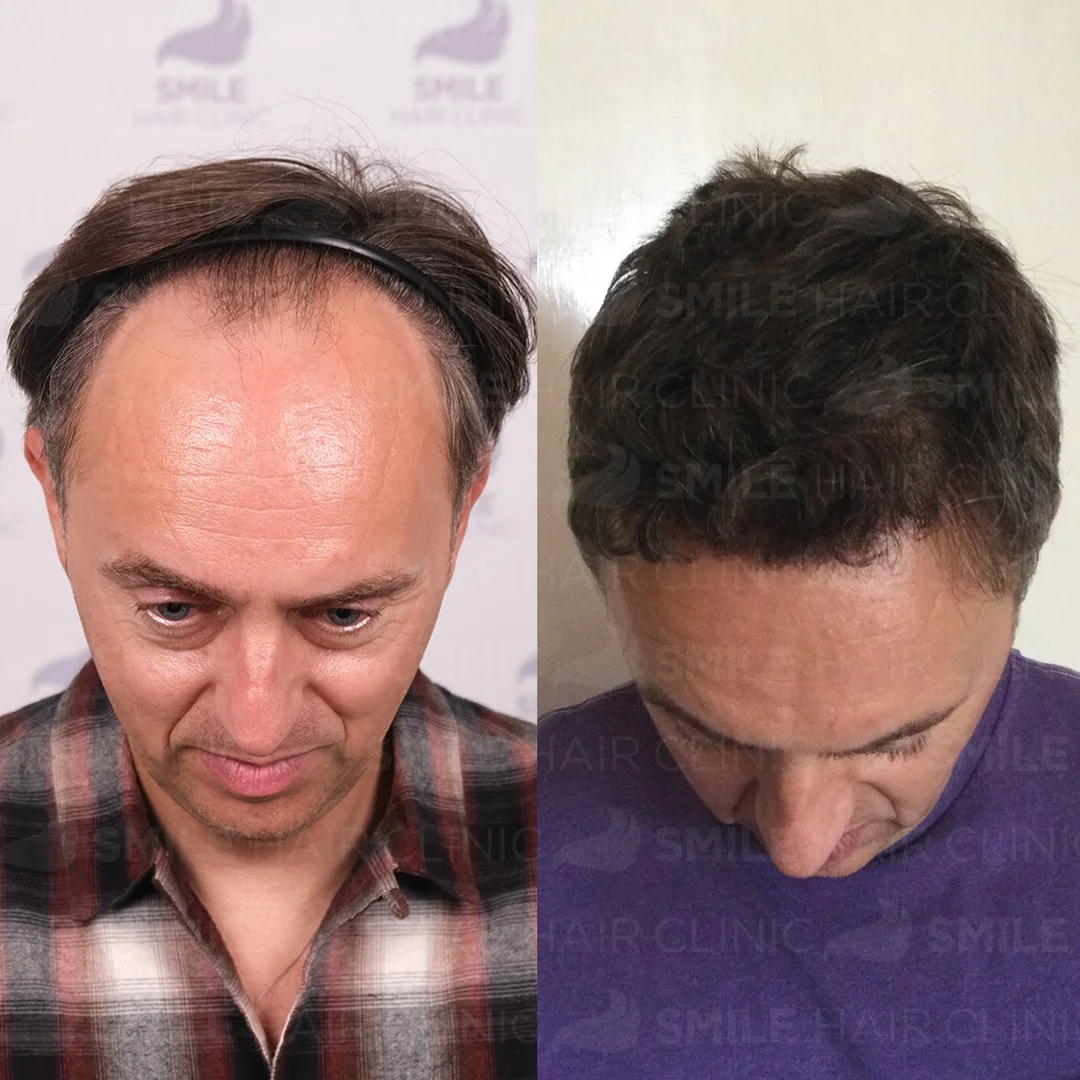 Before and after result 14