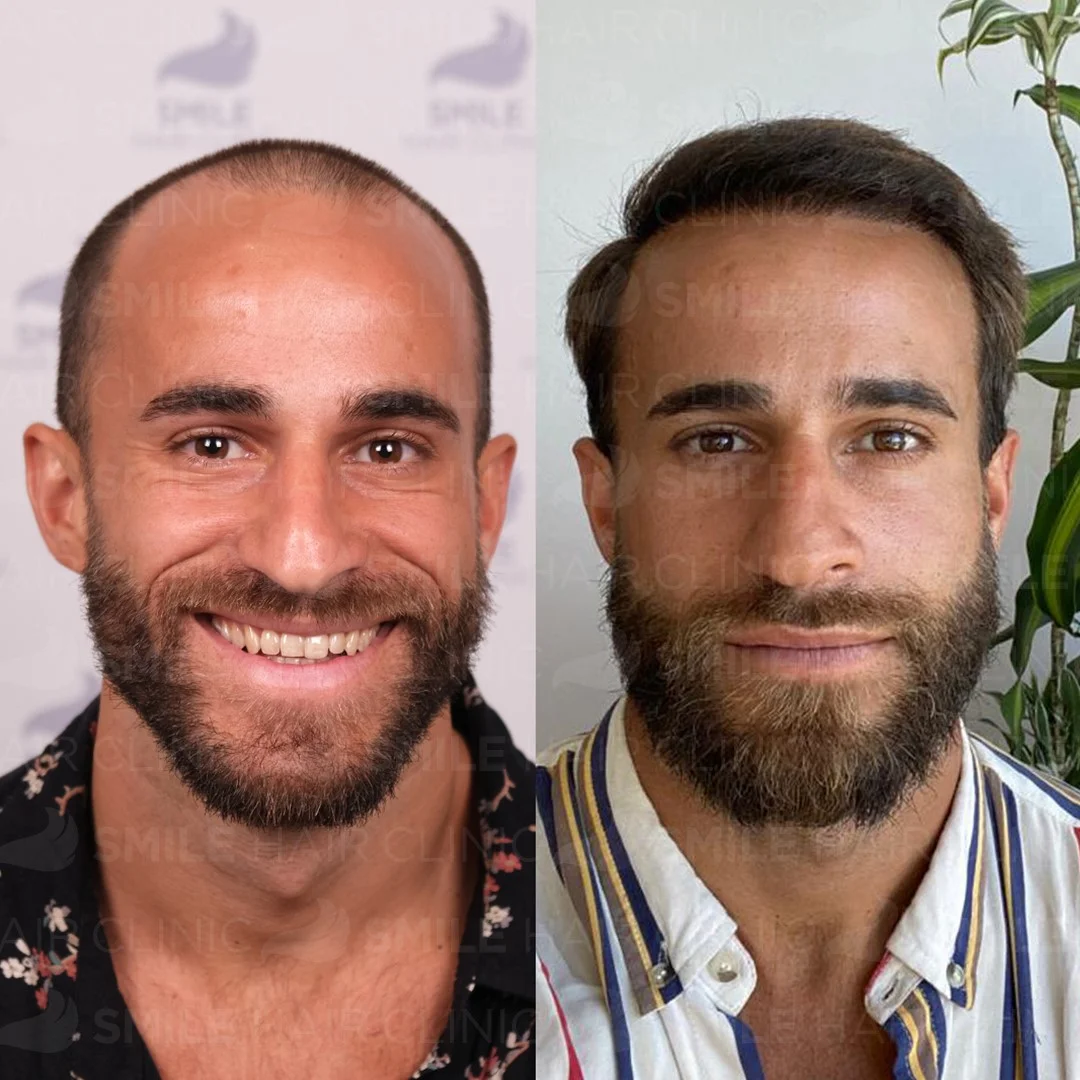 Before and after result 1