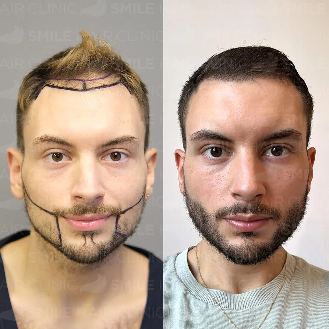 Before and after result 10