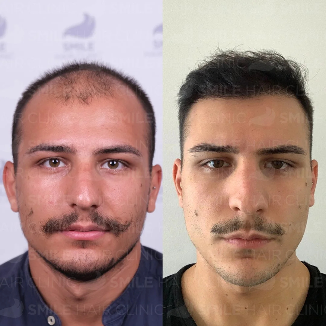 Before and after result 2