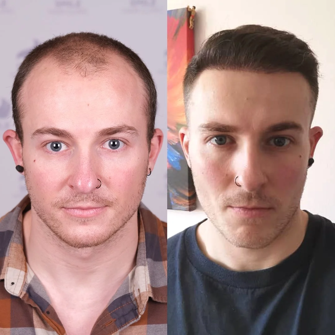 Before and after result 3