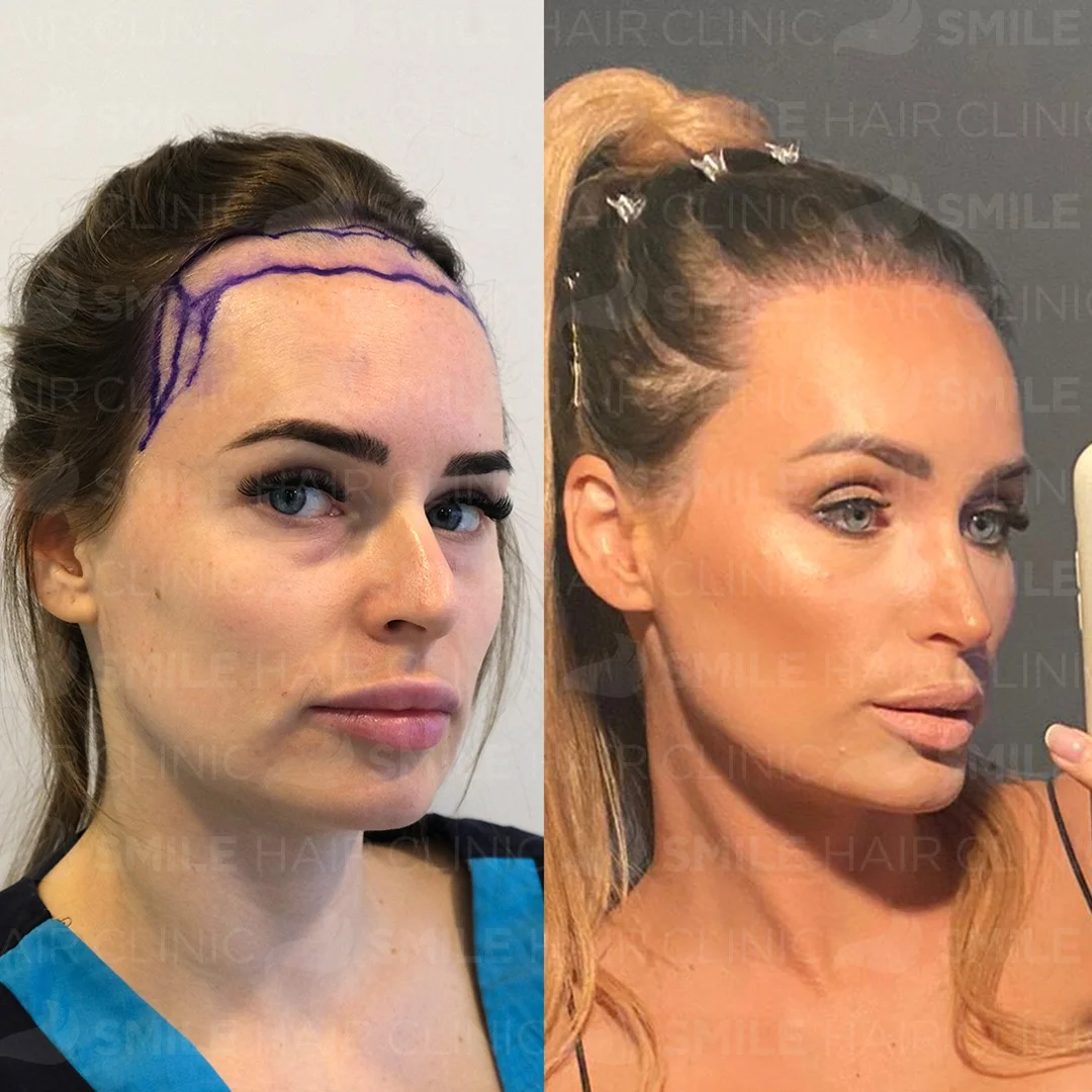 Before and after result 21