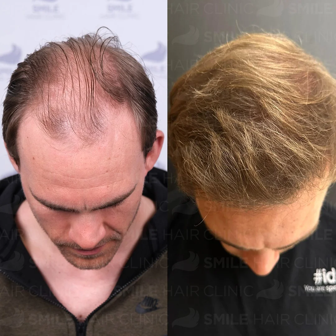 Before and after result 4