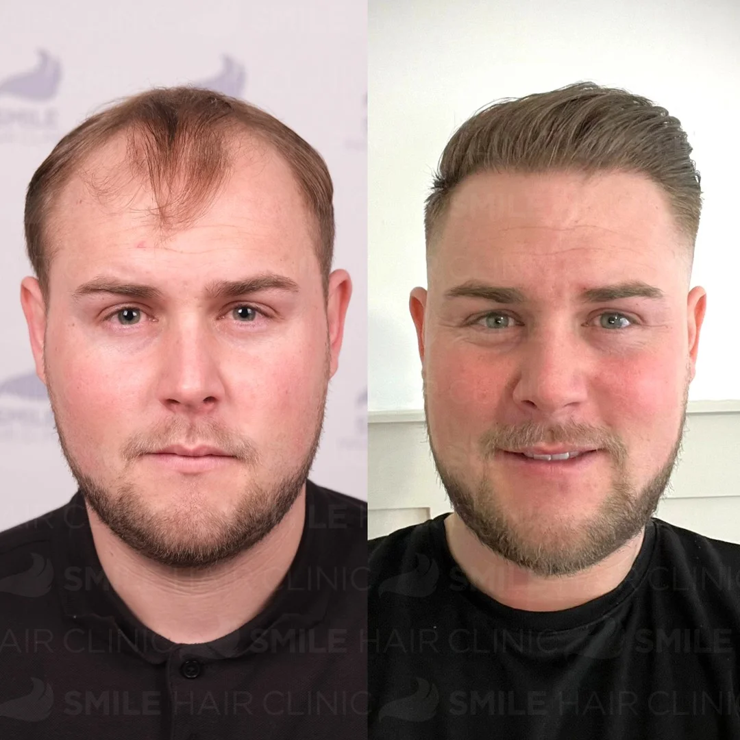 Before and after result 5