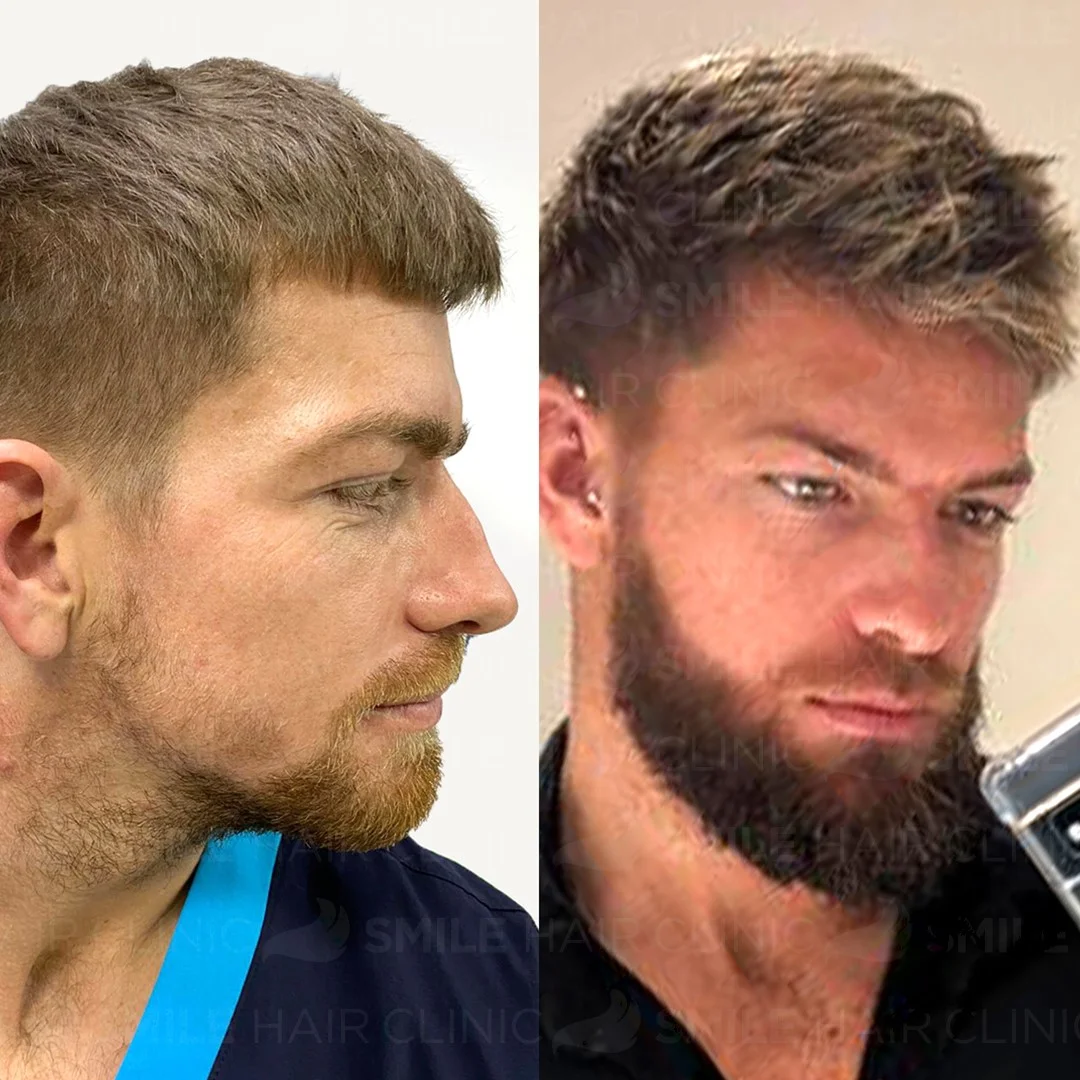 Before and after result 20