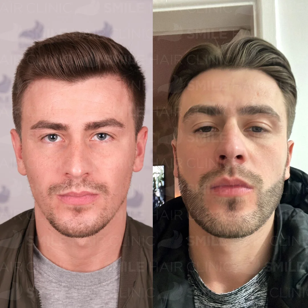 Before and after result 19