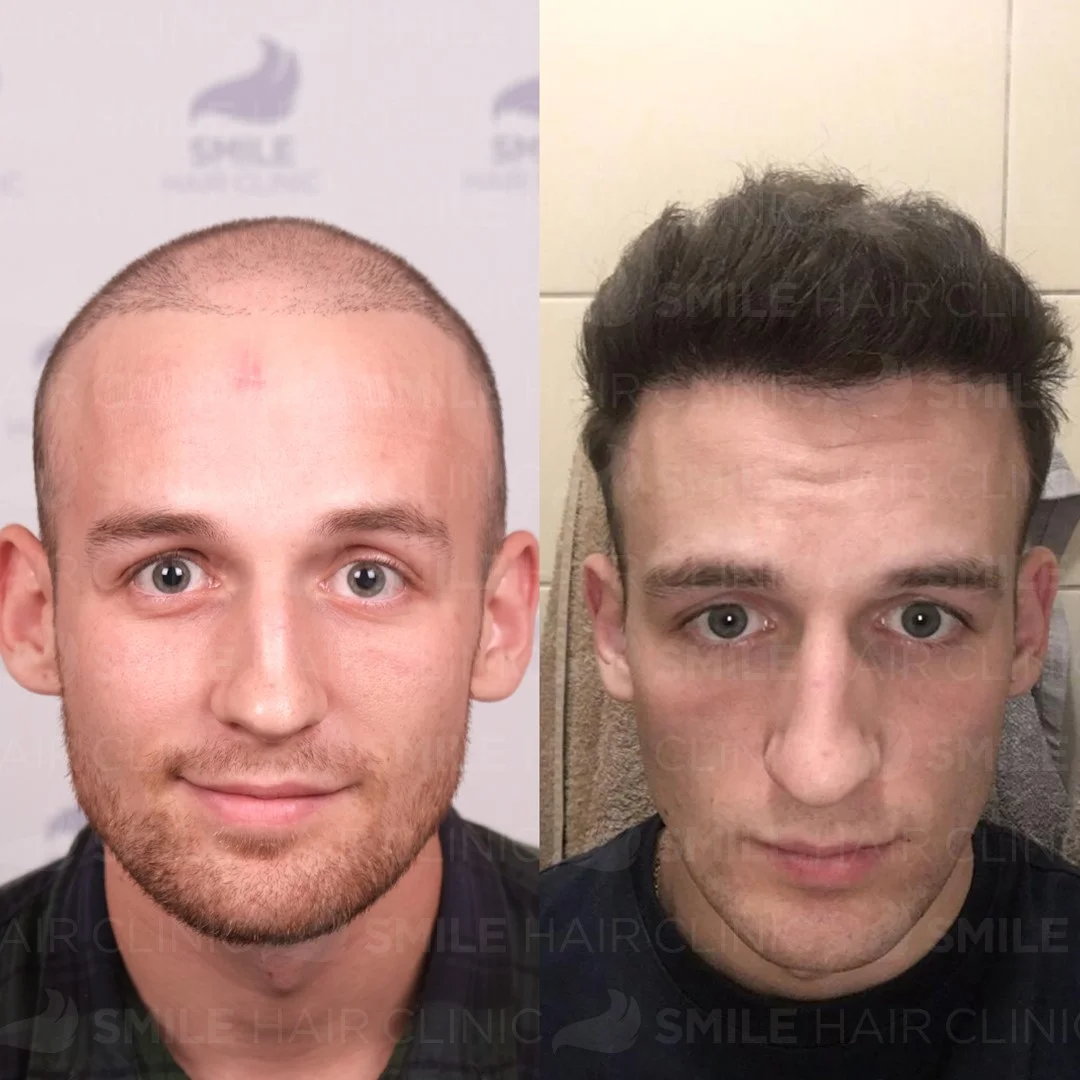 Before and after result 18