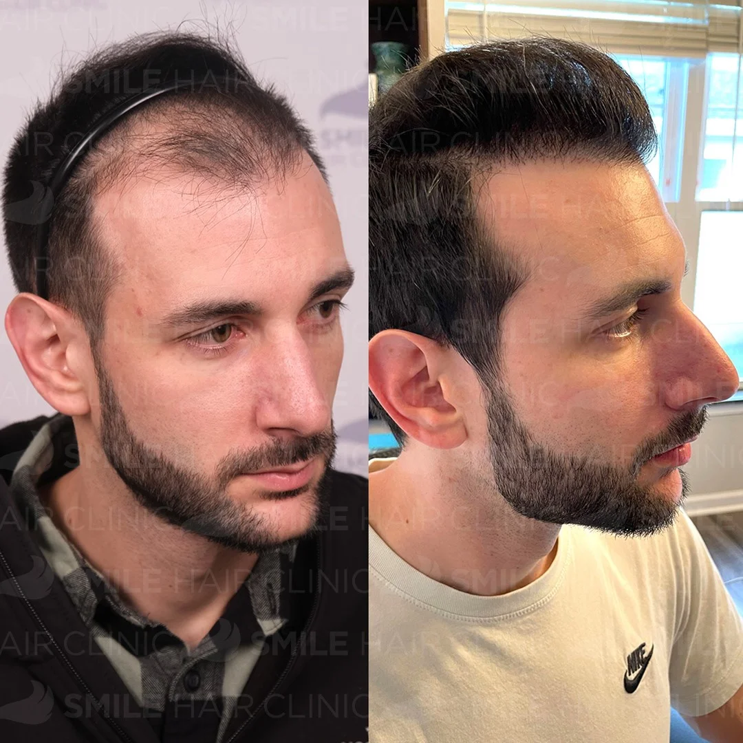 Before and after result 24