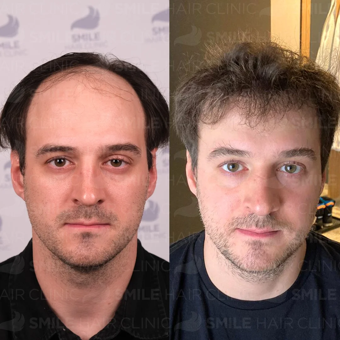 Before and after result 12