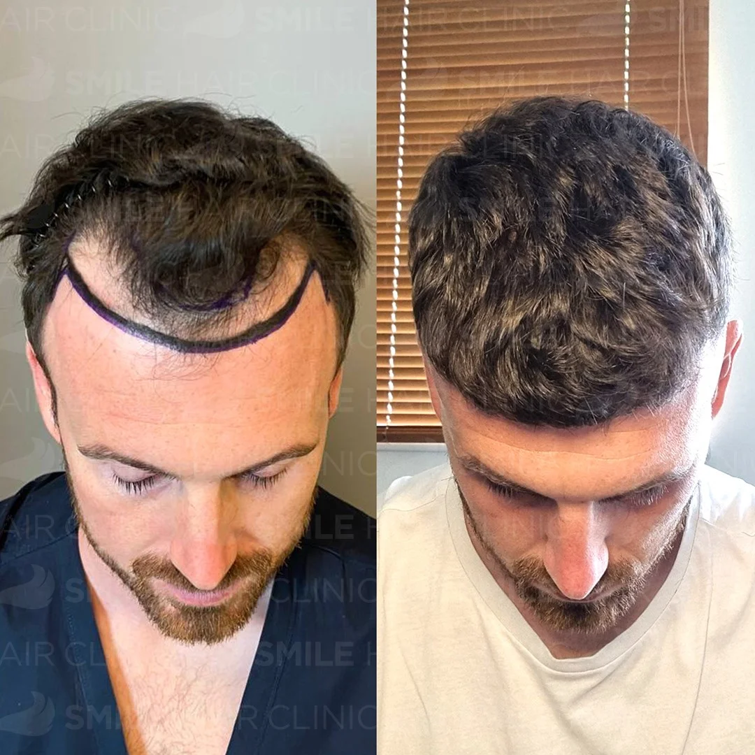 Before and after result 11