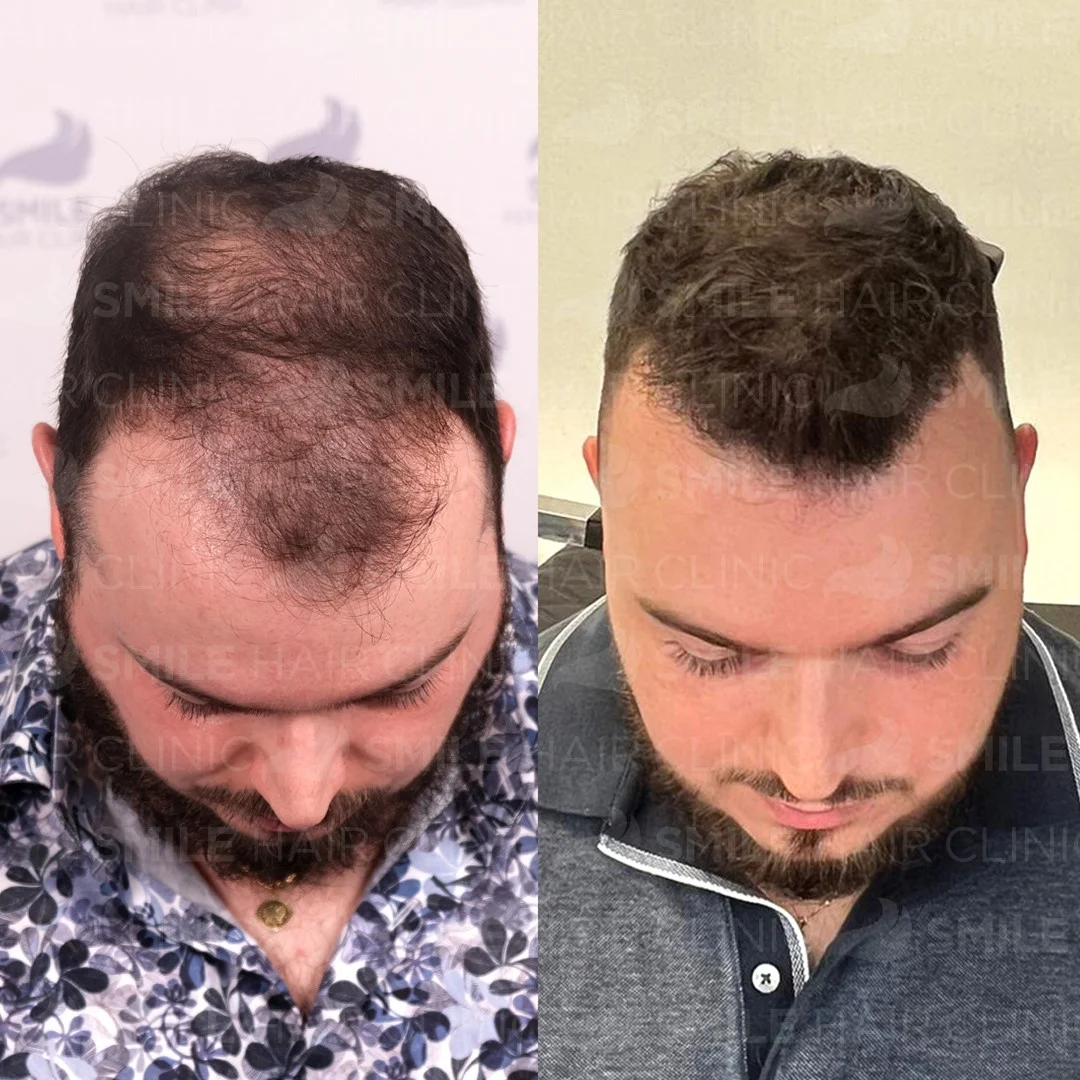 Before and after result 13