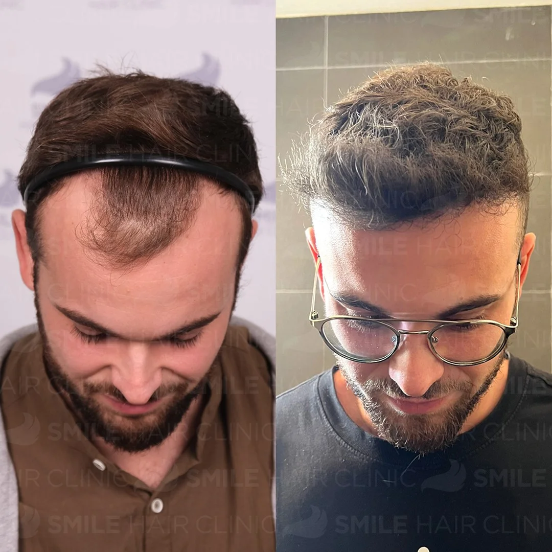 Before and after result 9