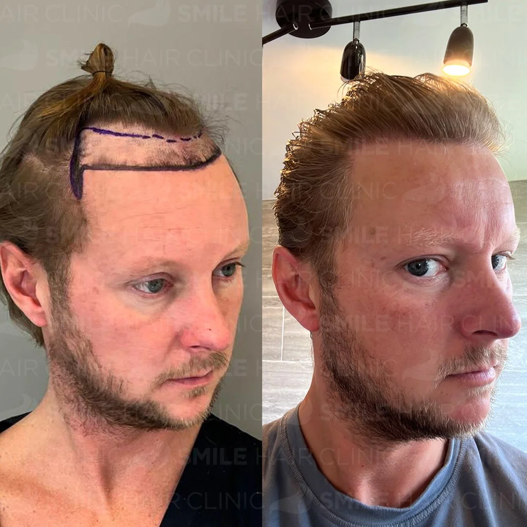 Before and after result 8