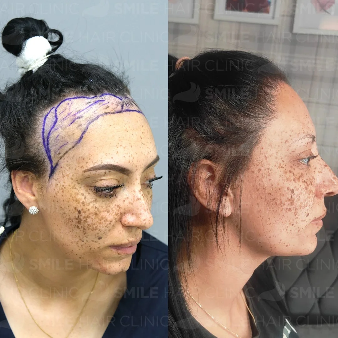 Before and after result 7