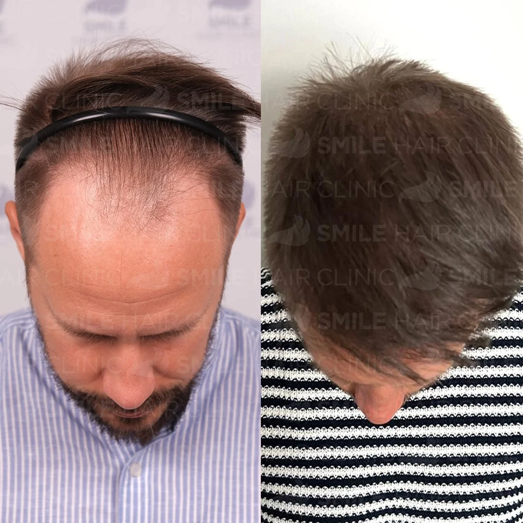 Before and after result 6