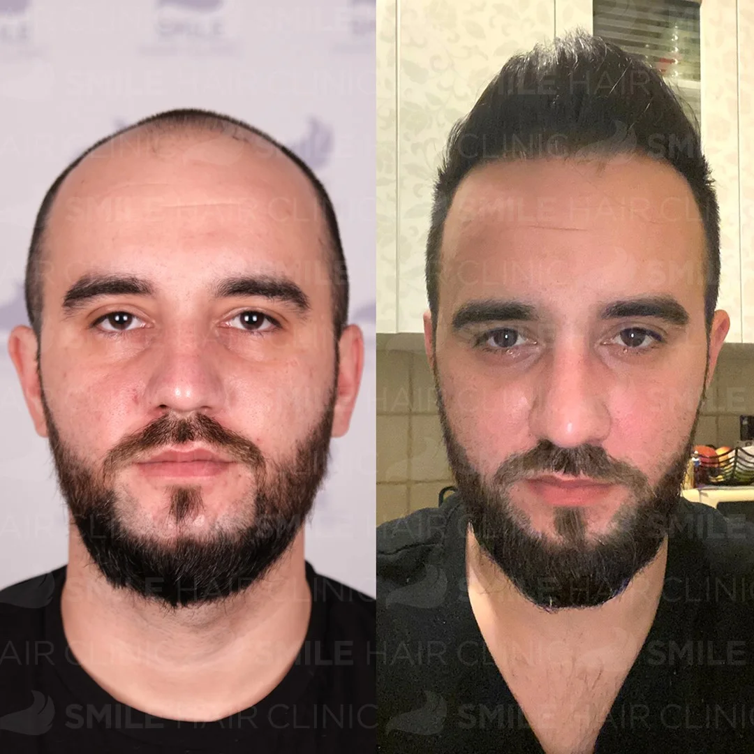 Before and after result 15