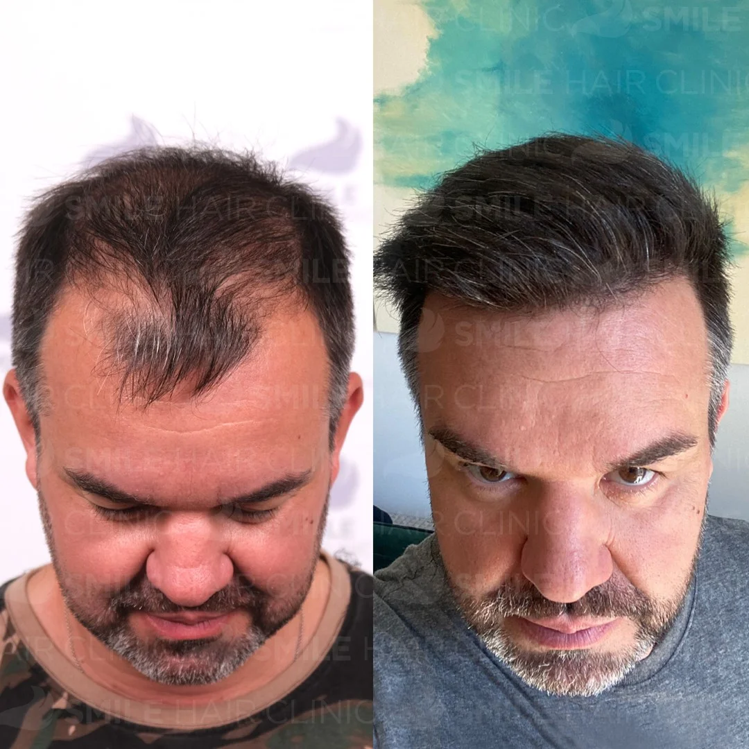 Before and after result 16